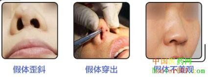 1528268512137449.jpg 假体歪斜.jpg