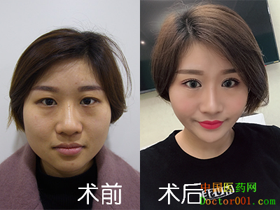 1530344144642265.png 文洁术前后对比照400-300.png