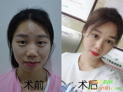 1530344134740094.png 家莉术前后对比照400-300.png