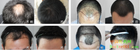 1534840651639021.png 植发对比.png