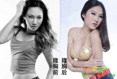 1536458519348464.jpg 自体隆胸案例.jpg