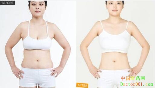 1552375681592522.jpg 吸脂1.jpg