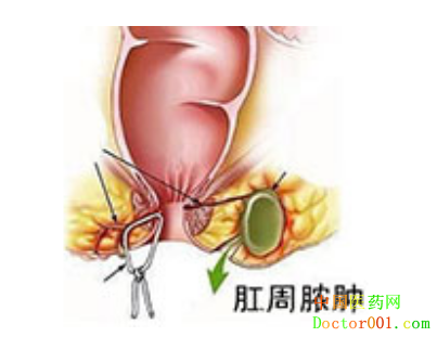一般肛周脓肿微创手术多少钱