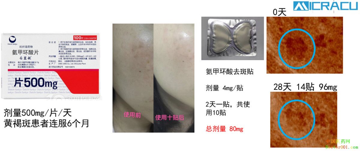 透皮给药替代“打针吃药”成新趋势,「中科微针」已实现微针贴剂规模量产